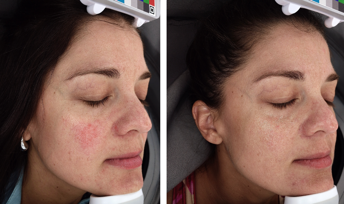 Redness Defense