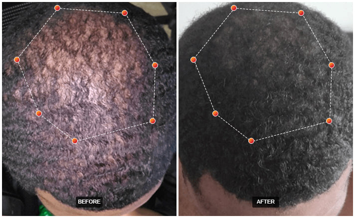 REVIAN RED Hair Growth Cap Dermatologist-Recommended Red Light Therapy for Hair Loss & Thinning Exclusive Pricing $1,500