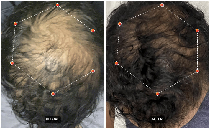 REVIAN RED Hair Growth Cap Dermatologist-Recommended Red Light Therapy for Hair Loss & Thinning Exclusive Pricing $1,500