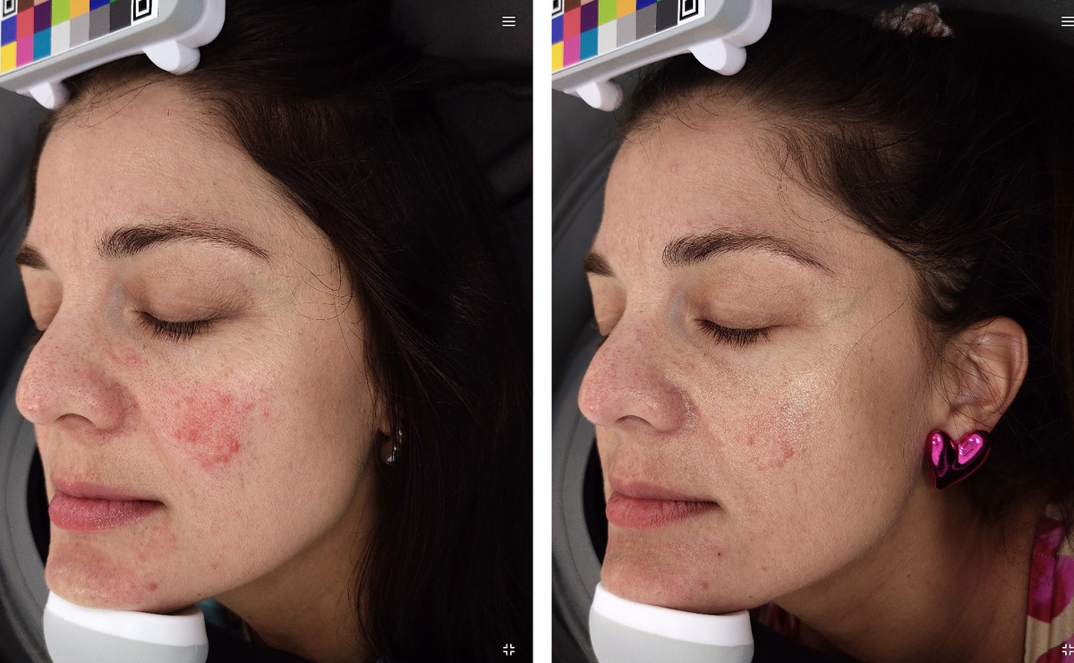 Redness Defense